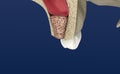 Sinus Lift Surgery - Sinus Augmentation. illustration