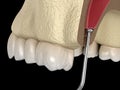 Sinus Lift Surgery - Moving sinus membrane. illustration