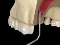 Sinus Lift Surgery - Moving sinus membrane. illustration