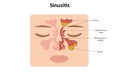 Sinusitis vector illustration Royalty Free Stock Photo