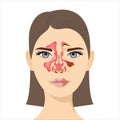 Sinusitis, Female face with inflammation of the mucous membrane of the paranasal and frontal sinuses