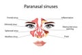 Sinusitis, Female face with inflammation of the mucous membrane of the paranasal and frontal sinuses