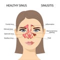 Sinusitis, Female face with inflammation of the mucous membrane of the paranasal and frontal sinuses.