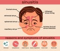 Sinusitis Flat Infographics