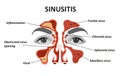 Sinusitis. Royalty Free Stock Photo