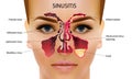 Sinusitis. Healthy and inflammation nasal sinus vector illustration Royalty Free Stock Photo