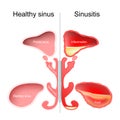 Sinusitis. Healthy nasal sinus and sinus with infection