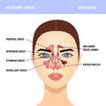 Sinusitis. Healthy and sinus infections, signs, realistic illustration for medical posters and educational materials Royalty Free Stock Photo