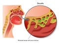 Sinusitis Royalty Free Stock Photo