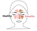 Sinusitis medical treatment. Healthy and inflammation sinus. Nasal diseases. Sinusitis, sinus infection diagnosis medical infogra