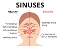 Sinusitis medical treatment. Nasal sinus. Healthy and inflammation sinus.