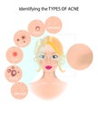 The six types of acne infographic