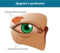 Sjogren`s syndrome or dry eye syndrome. Keratoconjuctivitis sicca