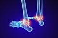 Skeletal foot - injuryd talus bone. Xray view. Medically accurate illustration Royalty Free Stock Photo