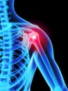 Skeletal shoulder with pain