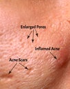 Skin with acne, acne scars, enlarged pores.