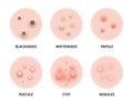 Skin acne types diagram. Vector skin disease pimples blackheads and comedones, cosmetology and skincare problems treatment