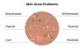 Skin acne types and face pimples for dark skin type, vector, skin care problems treatment. Skin acne dermatology and skincare