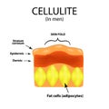 Skin aging in men. Cellulitis. Infographics. Vector illustration on background
