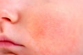 Skin allergy on the cheek of a newborn baby, macro photo. Diathesis on the face of Infante child, close-up Royalty Free Stock Photo