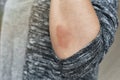 Skin allergy diseases problem, Close up of atopic dermatitis rash, Female dermatology patient with allergic eczema on arm.