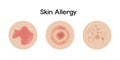 Skin allergy examples vector illustration design, dermatology problems. Royalty Free Stock Photo