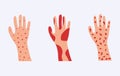 Skin allergy set. Hands covered red rash and scaling serious problems with psoriasis.