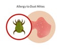 Skin allergy to dust mites vector illustration design Royalty Free Stock Photo