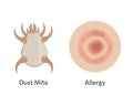 Skin allergy to dust mites vector illustration design. Royalty Free Stock Photo