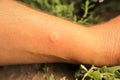 Skin allergy. Yellow wasp: stung by a wasp worker. Hornet stings a man`s arm Royalty Free Stock Photo