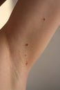 The skin on the armpits after removal of papillomas by laser