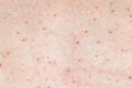 Skin background texture with pimples and blackheads. problematic skin close up. acne diseases