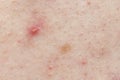 Skin background texture with pimples and blackheads. problematic skin close up. acne diseases