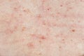 Skin background texture with pimples and blackheads. problematic skin close up. acne diseases