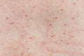 Skin background texture with pimples and blackheads. problematic skin close up. acne diseases