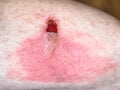 Skin burn with blisters on male hip Royalty Free Stock Photo