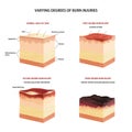 Skin burn classification.