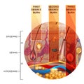 Skin burn classification in round shape Royalty Free Stock Photo