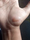 Skin burn forming bubble