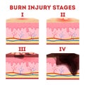 Skin burn injury stages. Anatomy of the skin. Royalty Free Stock Photo