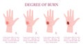 Skin burn injury stages infographic. Red skin and blisters, thermal