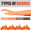 Skin burn injury treatment and stages infographic. damage from fire. Red skin. Isolated vector illustration in cartoon