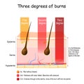 Skin burn. Three degrees of burns. type of injury to skin