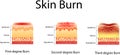 Skin burn. Three degrees of burns. type of injury to skin, Vector illustration Royalty Free Stock Photo