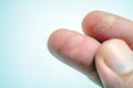 Burnt fingers, Finger fire Caused by negligence, skin burn on finger