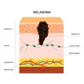 Skin cancer anatomy Royalty Free Stock Photo