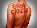 Skin Cancer Melanoma Royalty Free Stock Photo