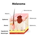 Skin cancer. Melanoma Royalty Free Stock Photo