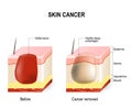 Skin cancer Royalty Free Stock Photo
