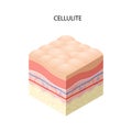 Skin with cellulite cross-section of human skin layers structure skincare medical concept flat